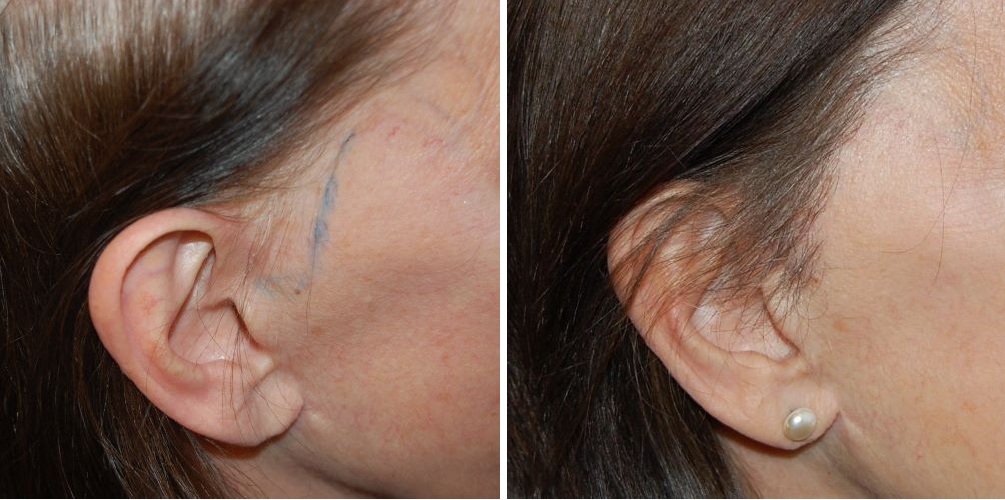 Female patient's sideburn before and 6 months after hair transplant surgery at the Wimpole Clinic