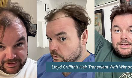 Lloyd Griffith Hair Transplant Wimpole Clinic
