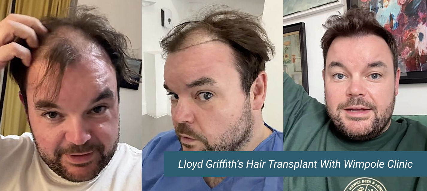 Lloyd Griffith Hair Transplant Wimpole Clinic