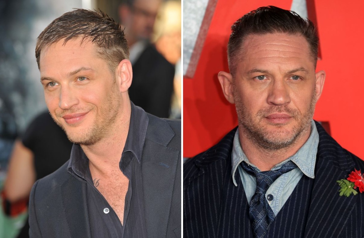 Left: Tom Hardy&rsquo;s hairline in 2010. Right: Tom Hardy&rsquo;s hairline in 2025.
