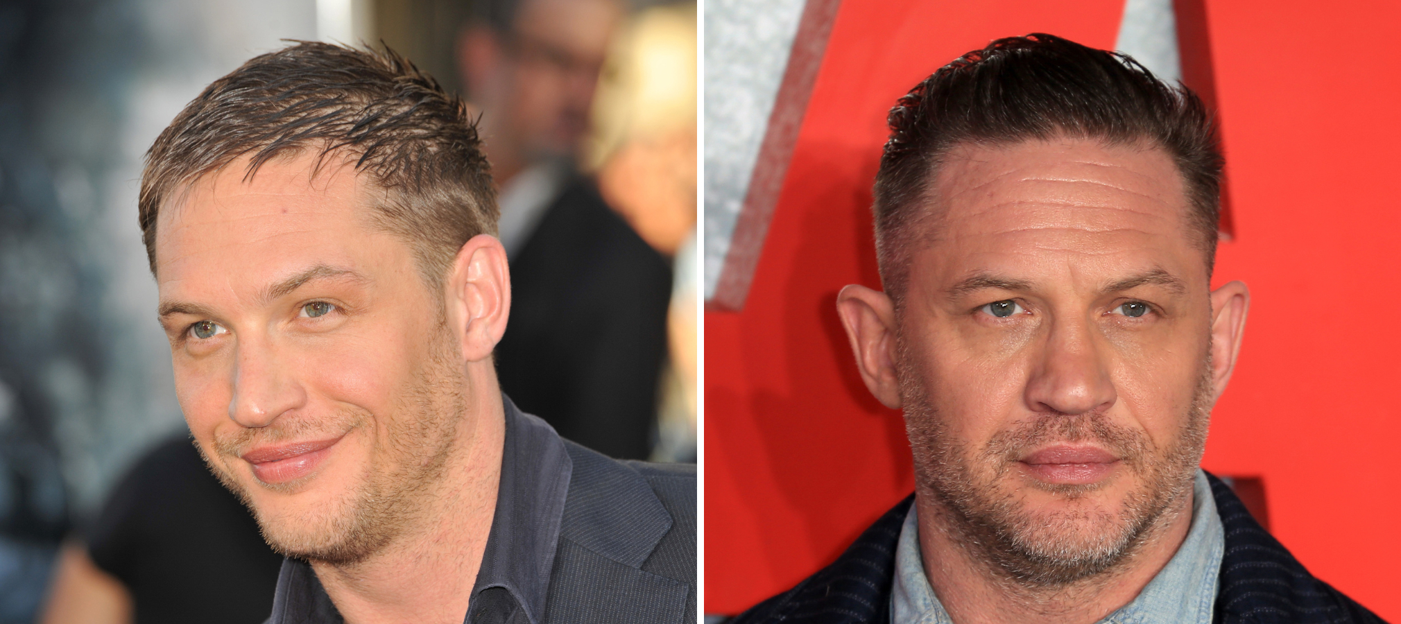 tom hardy hair transplant featured image