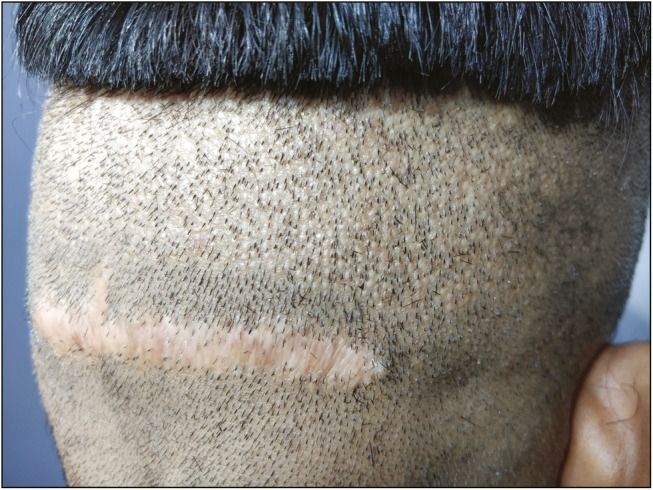 A patient has a very wide scar following poor closure after FUT surgery