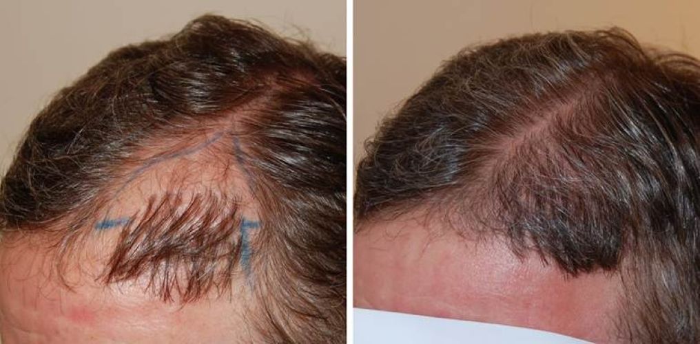 Before and 7 months after a 500 graft hair transplant repair procedure