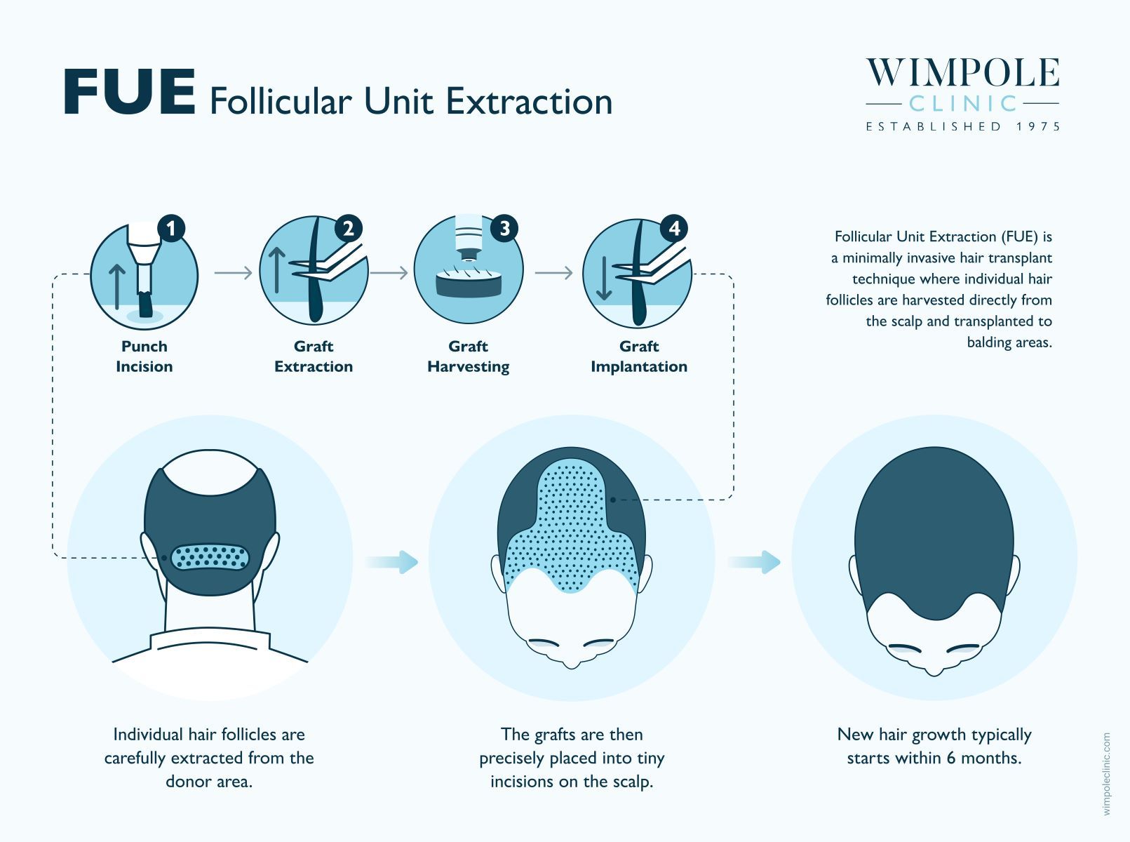 FUE hair transplant