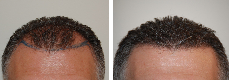 Wimpole patient before and 6 months after the 1100-graft FUT hairline transplant