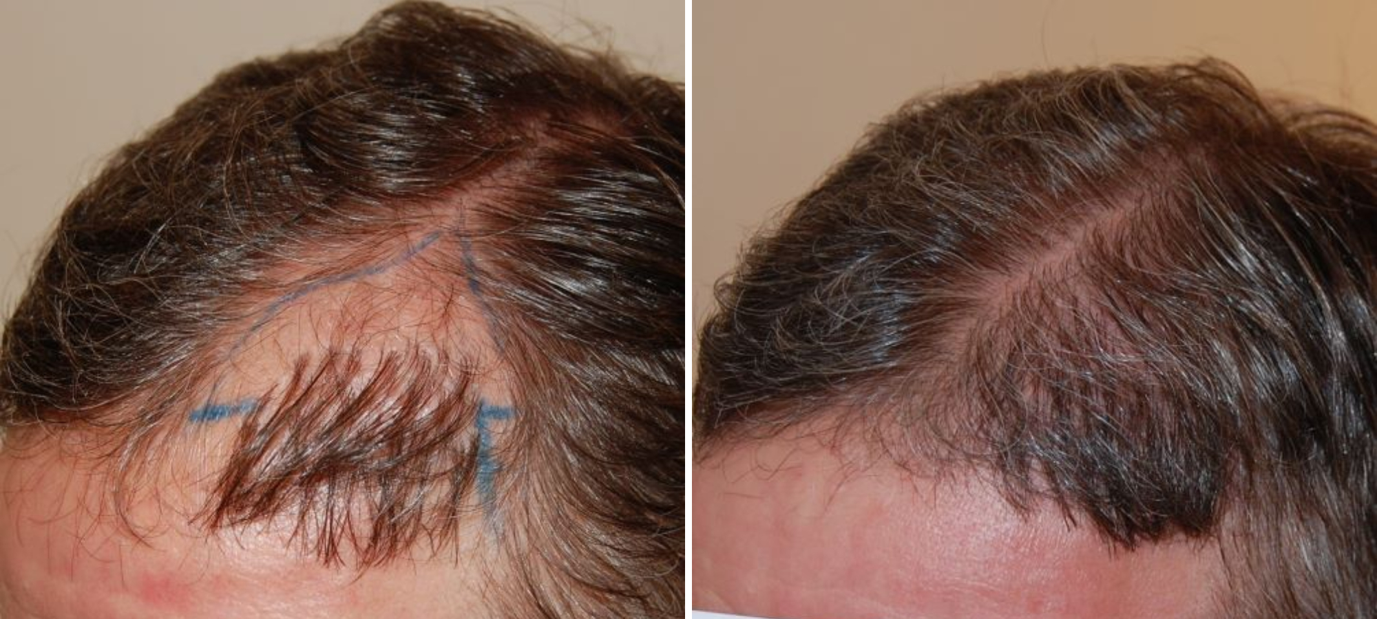 hair transplant repair featured image