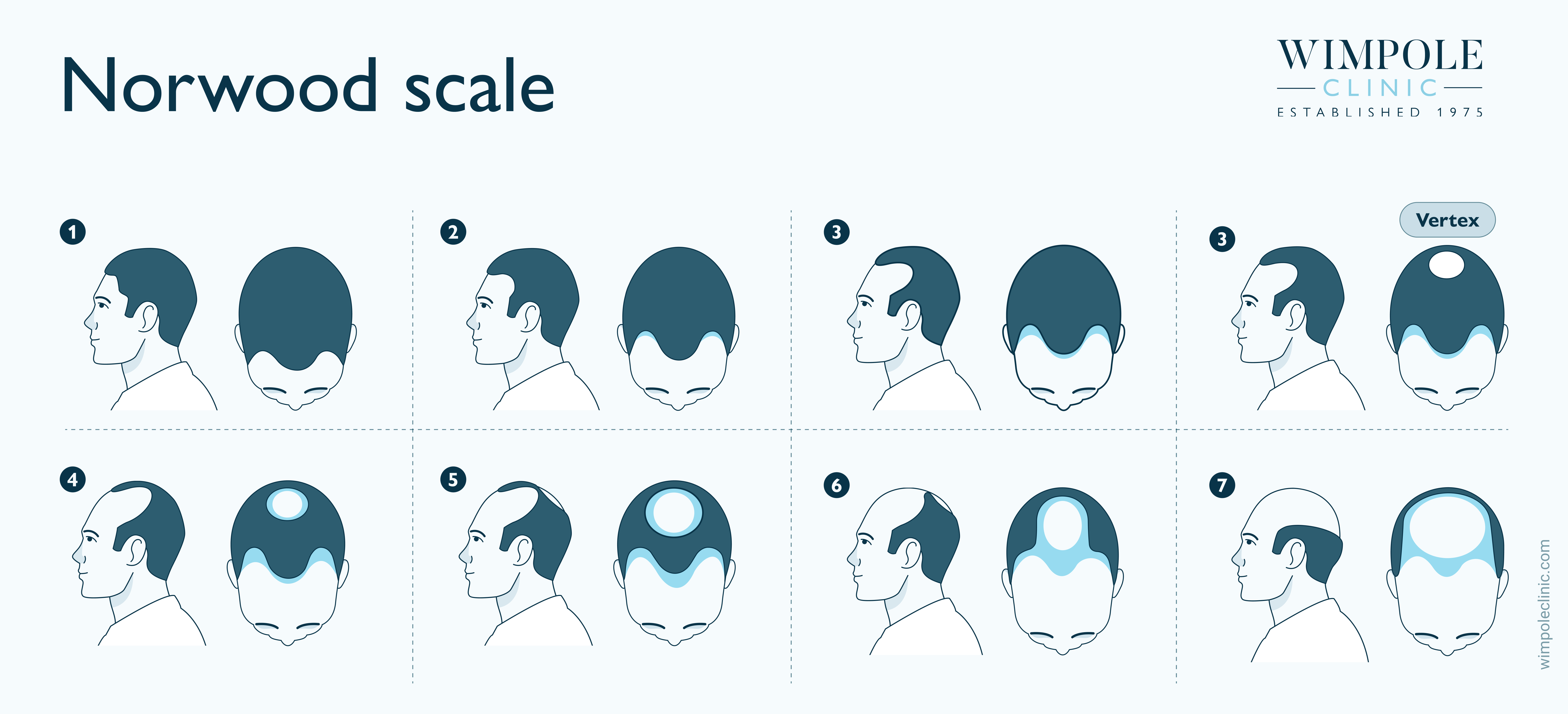 Norwood scale 1