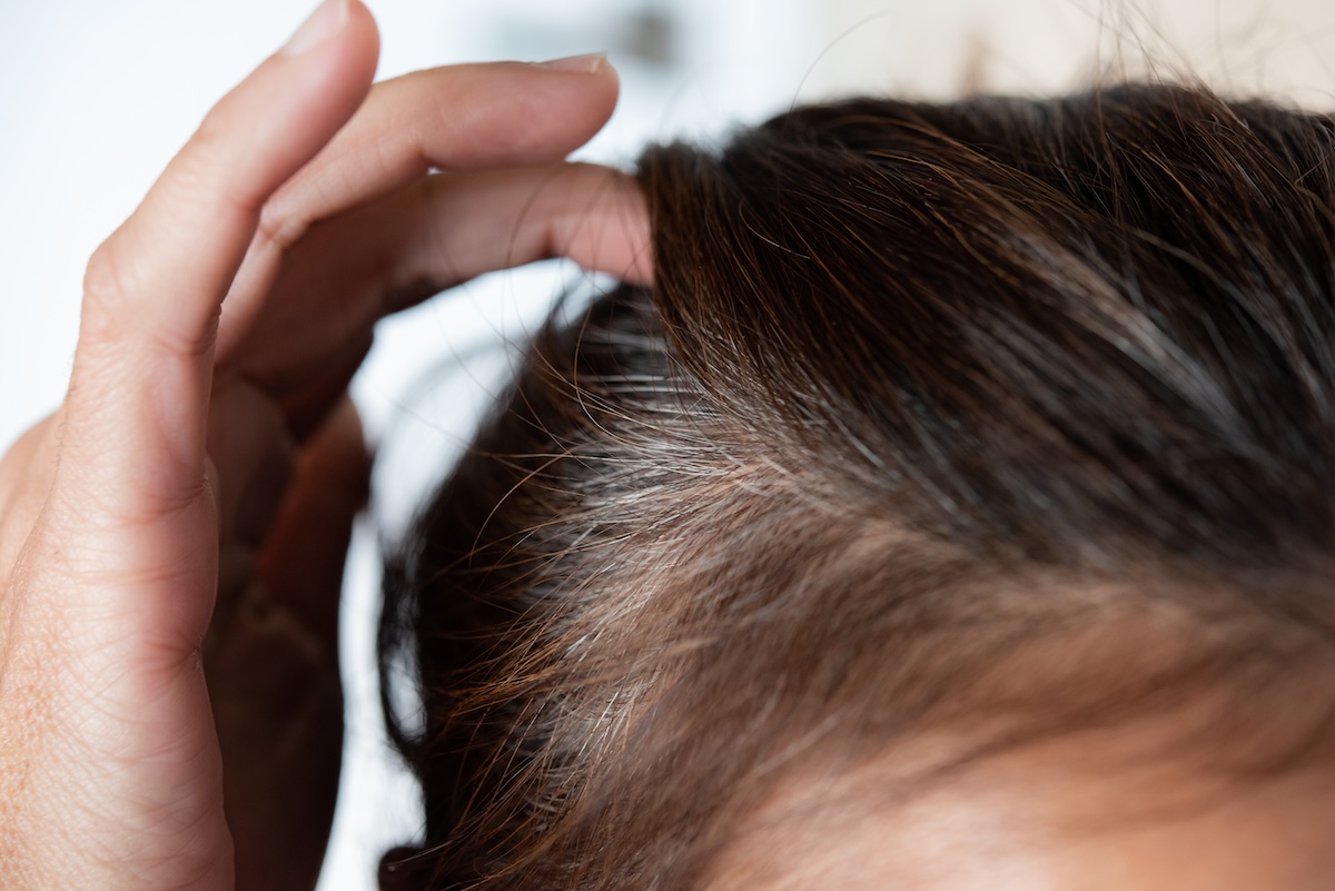 does stress cause grey hair