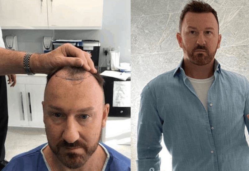 FUT Hair Transplant, Wimpole Clinic