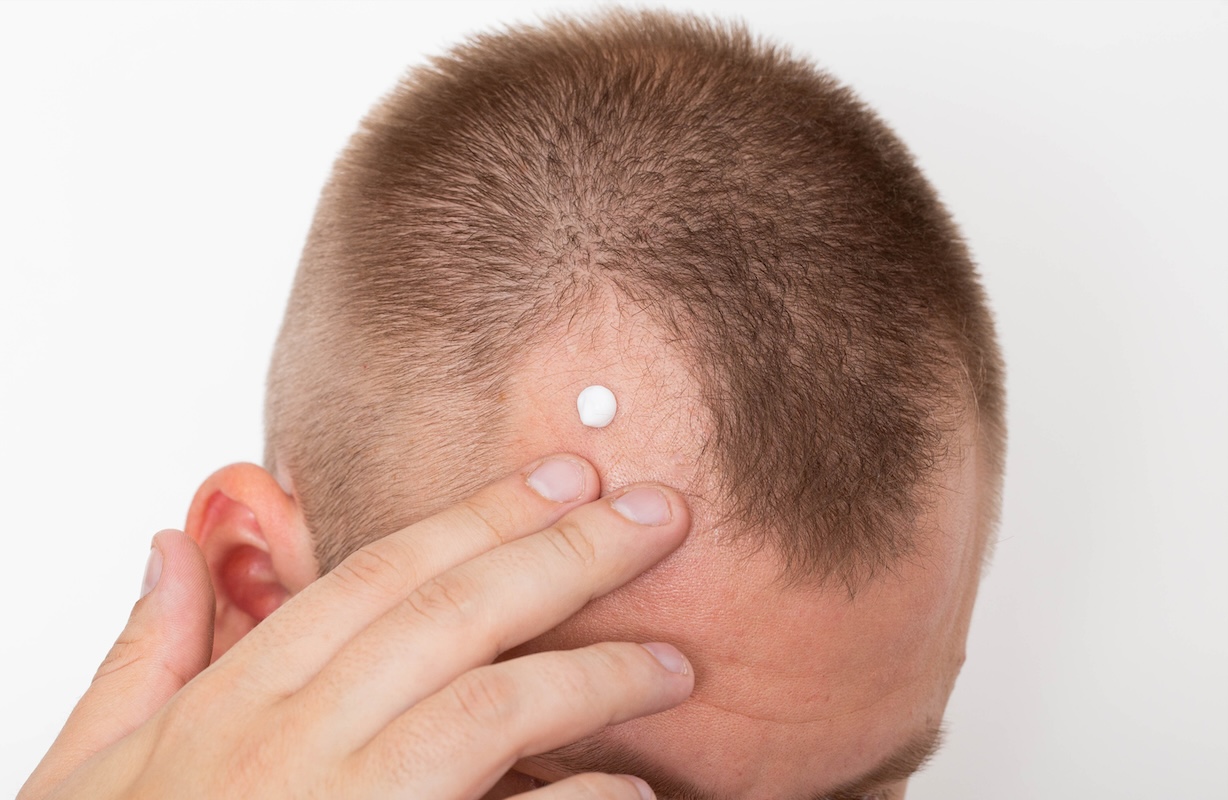 clascoterone hair loss