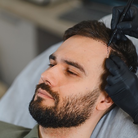 hair transplant guarantee featured image