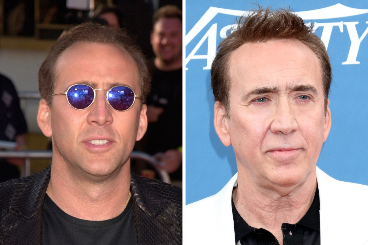 nicolas cage hair transplant