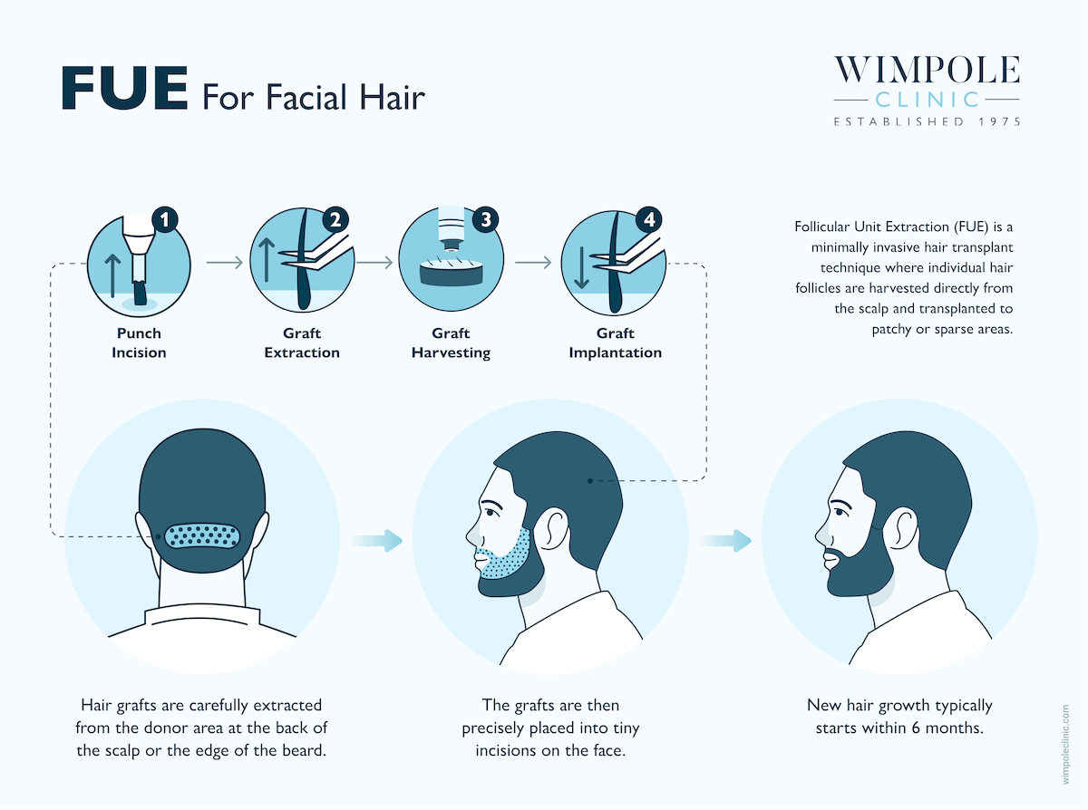 Conor Benn&rsquo;s Beard Transplant: Results & Reaction, Wimpole Clinic