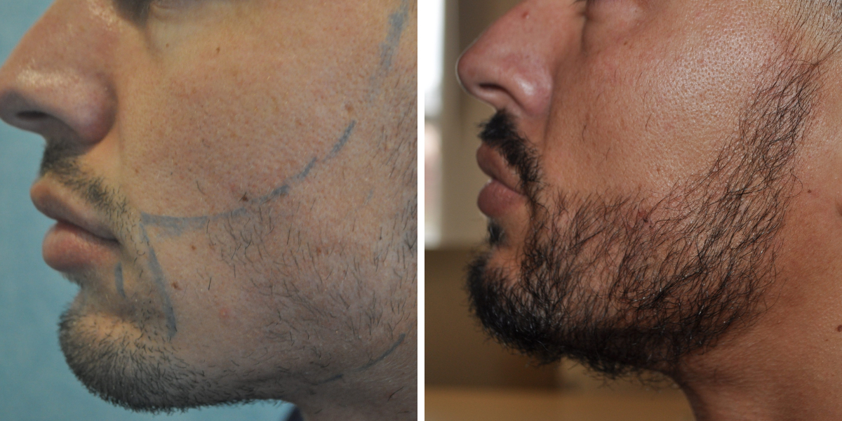Conor Benn&rsquo;s Beard Transplant: Results & Reaction, Wimpole Clinic