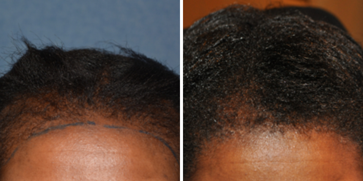 Why Black Women Wear Wigs &mdash; And How They Impact Natural Hair, Wimpole Clinic