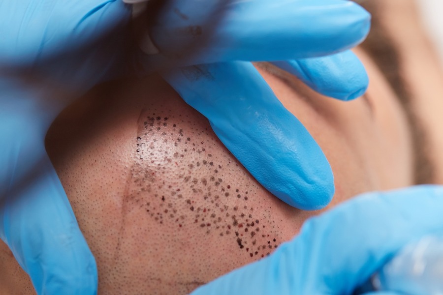 Hairline Tattoo Featured Image