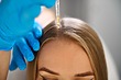 Hair Loss