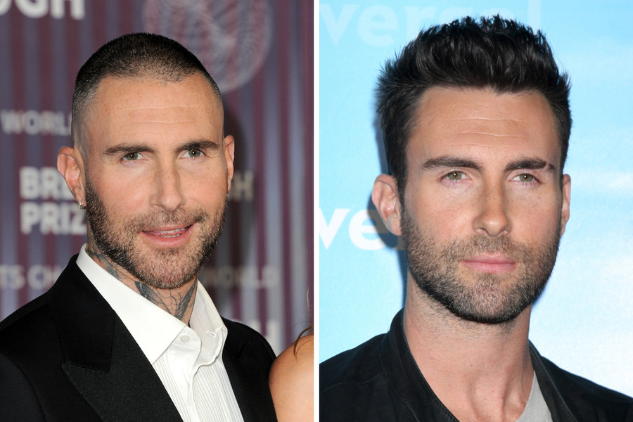 Adam Levine Hair Transplant