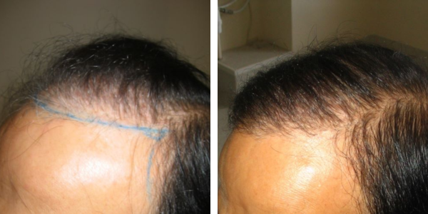 asian fut hair transplant before and after