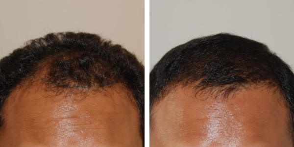 asian hair transplant before and after 2