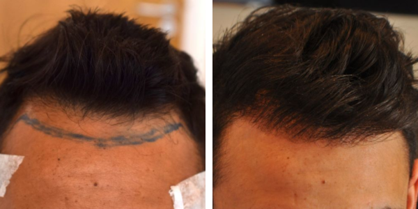 asian hair transplant before and after