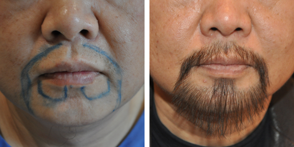 The Complete Guide to Facial Hair Transplants, Wimpole Clinic
