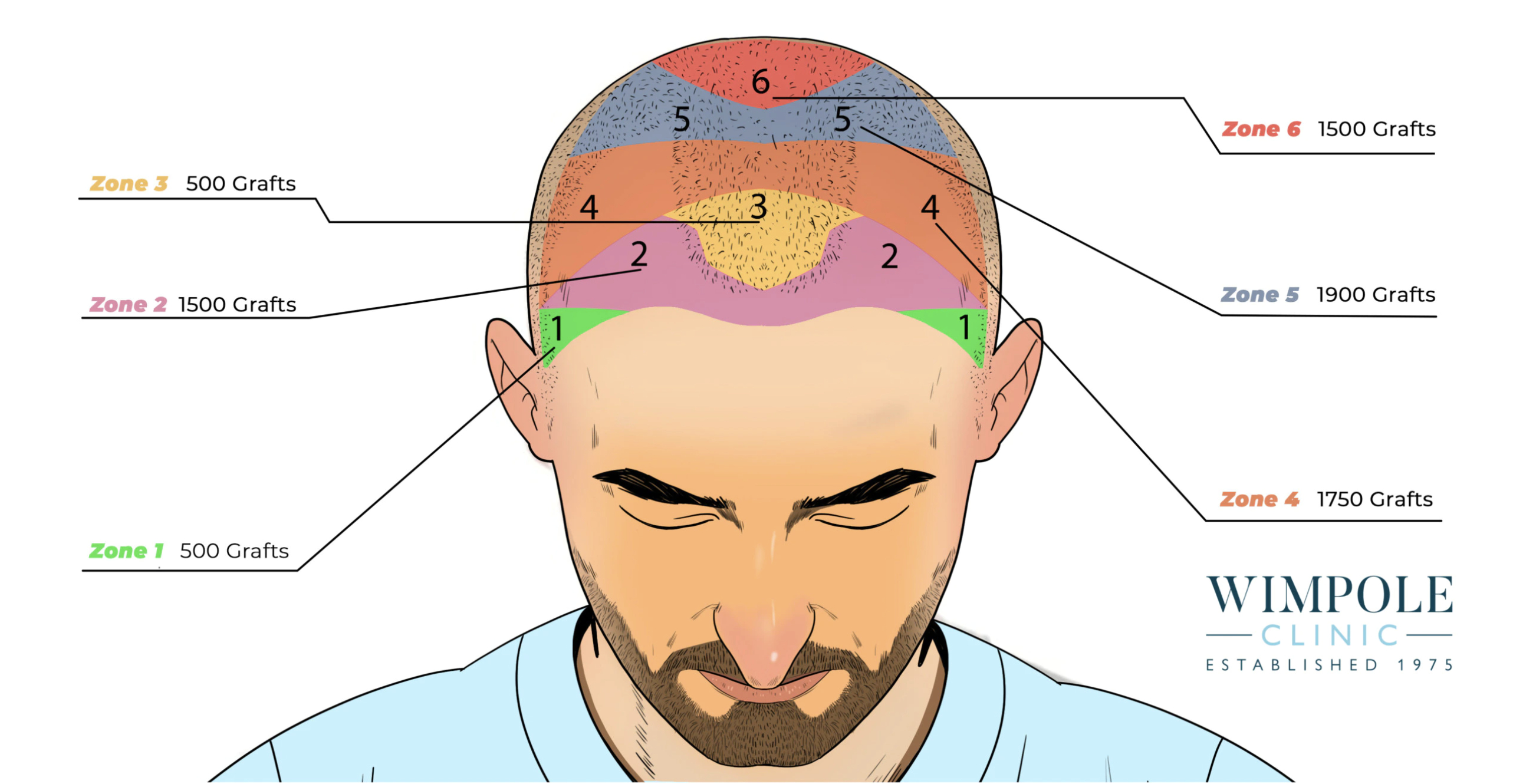 Has Adam Levine Had A Hair Transplant?, Wimpole Clinic