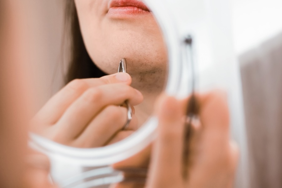 Minoxidil Hypertrichosis