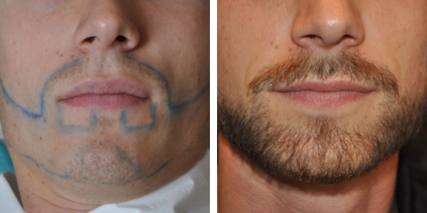 moustache transplant case study