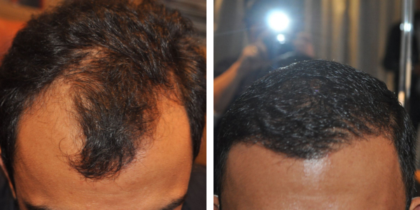 south asian hair transplant before and after