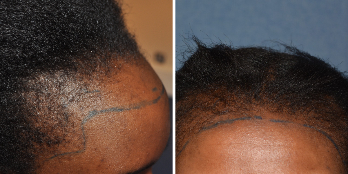 black women with traction alopecia