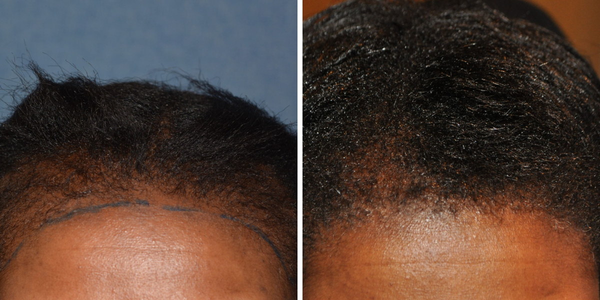 hair transplant for traction alopecia in black woman