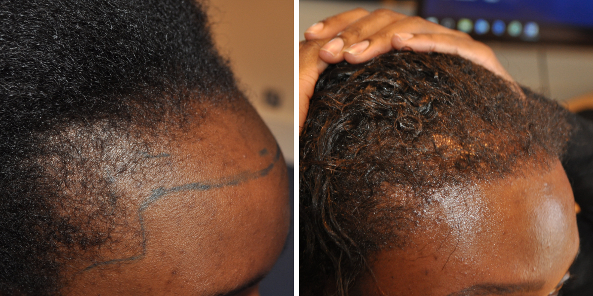 Alopecia in Black Women: Common Causes & How To Diagnose It, Wimpole Clinic