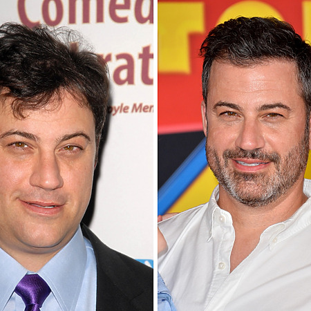 jimmy kimmel hair transplant before and after