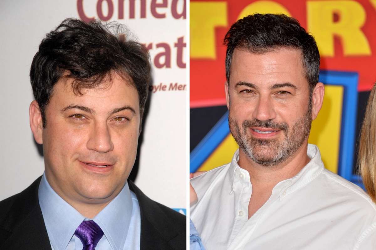 jimmy kimmel hair transplant before and after