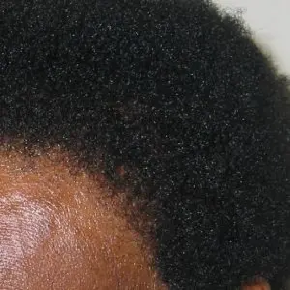 FUT Hair Transplants: Facts, Costs & Results, Wimpole Clinic