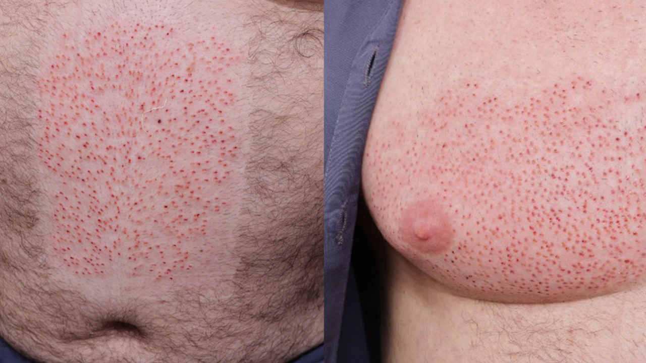 body donor areas after graft harvesting for a hair transplant