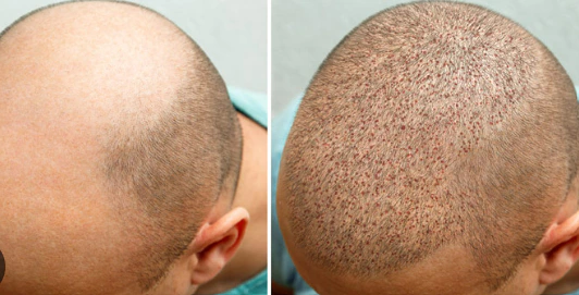 Before and 7 days after crown hair transplant