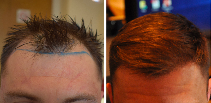 before and 10 months after FUE hair transplant procedure to treat male pattern baldness