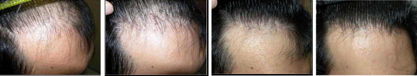 Finasteride for hairline: before and after taking 1mg Finasteride per day