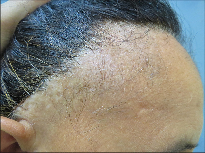 Woman with frontal-fibrosing alopecia