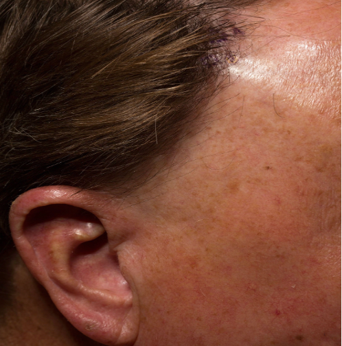 Frontal Fibrosing Alopecia: Causes, Symptoms & Treatments, Wimpole Clinic