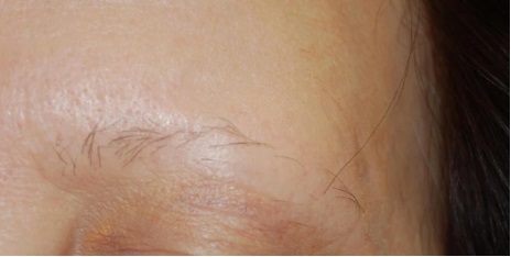 Frontal Fibrosing Alopecia: Causes, Symptoms & Treatments, Wimpole Clinic