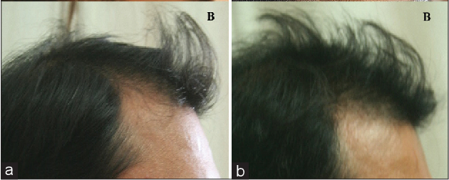 Before and after hair growth results in male pattern hair loss patient from Minoxidil 5% twice daily usage for 4 months.