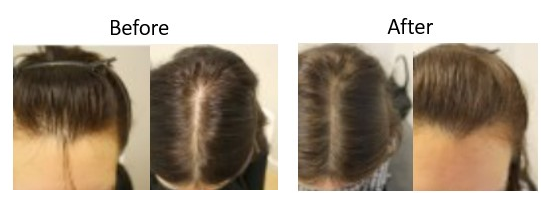 Before and after Minoxidil results after 1 year for female pattern baldness&nbsp;