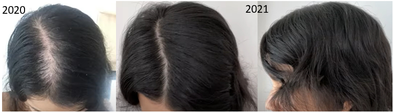 Minoxidil results after 1 year for female pattern baldness&nbsp;