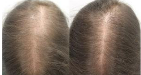 Oral Minoxidil results after 1 year for female pattern baldness&nbsp;