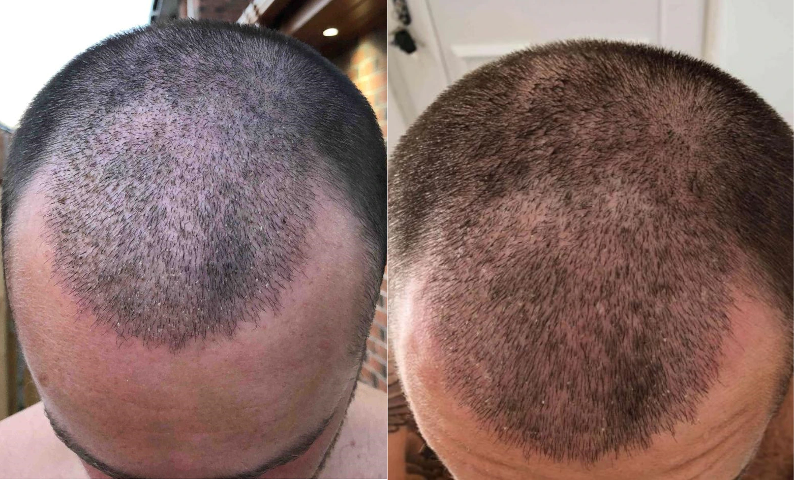 Scalp 2 weeks post-surgery