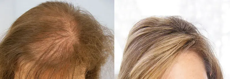 woman before and after artificial hair transplant