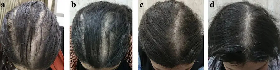 Does topical Minoxidil work for women? Hair regrowth results in female pattern baldness patient
